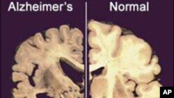 This undated image provided by Merck & Co., shows a cross section of a normal brain (right) and one of a brain damaged by advanced Alzheimer's disease, December 3, 2012.