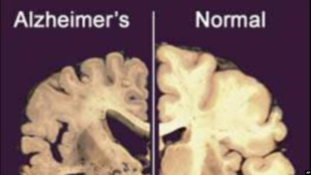 This undated image provided by Merck & Co., shows a cross section of a normal brain (right) and one of a brain damaged by advanced Alzheimer's disease, December 3, 2012