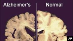 This undated image provided by Merck & Co. shows a cross section of a normal brain (right) and one of a brain damaged by advanced Alzheimer's disease. 