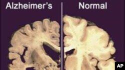 This undated image provided by Merck & Co., shows a cross section of a normal brain (right) and one of a brain damaged by advanced Alzheimer's disease, December 3, 2012