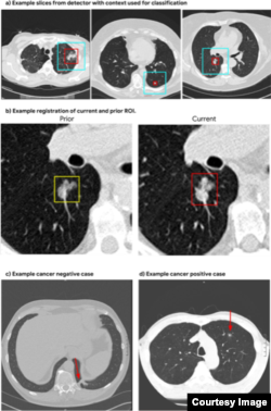 Examples shown are images used to detect lung cancer. When examining a CT scan for diagnosis, the deep-learning model performed equal to or better than six radiologists, said the study published in Nature Medicine. (Nature Medicine)