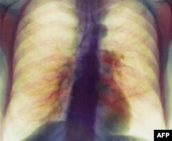 Hronična bolest pluća blokira protok vazduha
