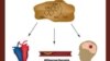 High cholesterol causes - heart attack, stroke, atherosclerosis.