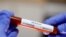 Ống xét nghiệm virus corona với kết quả dương tính (ảnh chụp ngày 29/1/2020)