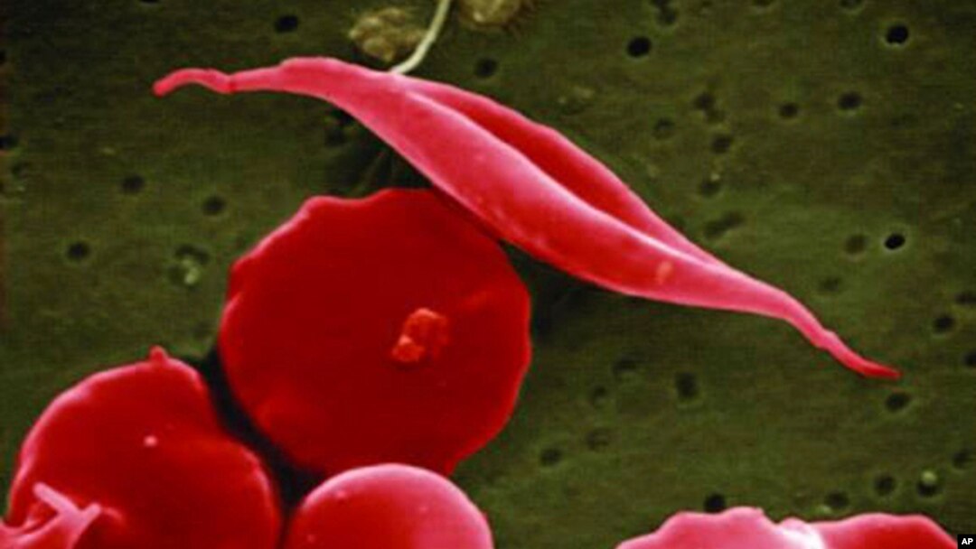 Bentuk sel darah merah yang terkena penyakit sel sabit. (Foto: NCATS, National Institutes of Health via AP)