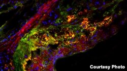 A new study shows that a type of natural sugar called trehalose triggers an important cellular housekeeping process in immune cells that helps treat atherosclerotic plaque. The image shows a cross section of a mouse aorta, the main artery in the body, with a large plaque. Straight red lines toward the upper left are the wall of the aorta. Yellow areas are where housekeeping cells called macrophages are incinerating cellular waste. (Credit - Ismail Sergin, medicine.wustl.edu)