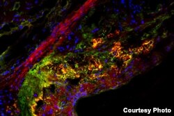 A new study shows that a type of natural sugar called trehalose triggers an important cellular housekeeping process in immune cells that helps treat atherosclerotic plaque.