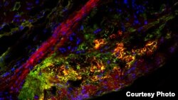 Sebuah studi baru-baru ini menunjukkan jenis gula alami yang disebut trehalose yang memicu proses bersih-bersih di tingkat sel di sel-sel kekebalan tubuh yang membantu menangani atherosclerotic plaque. Citra di atas menunjukkan penampang nadi seekor tikus, pembuluh darah utama di tubuh dengan plak berukuran besar. Garis merah lurus yang mengarah ke bagian kiri atas adalah dinding urat nadi. Daerah yang berwarna kuning adalah sel-sel pembersih yang disebut makrofaga yang membakar limbah sel (foto: Ismail sergin, medicine.wustl.edu)
