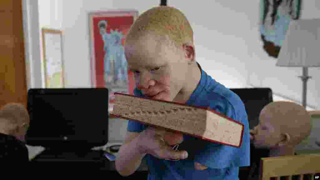 Albino Children Prosthetics