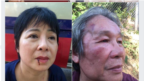 Bà Nguyễn Thúy Hạnh và ông Huỳnh Ngọc Chênh bị hành hung ngày 12-07-2019 khi đến các tù nhân ở Trại 6 Nghệ An. Facebook Nguyen Thuy Hanh