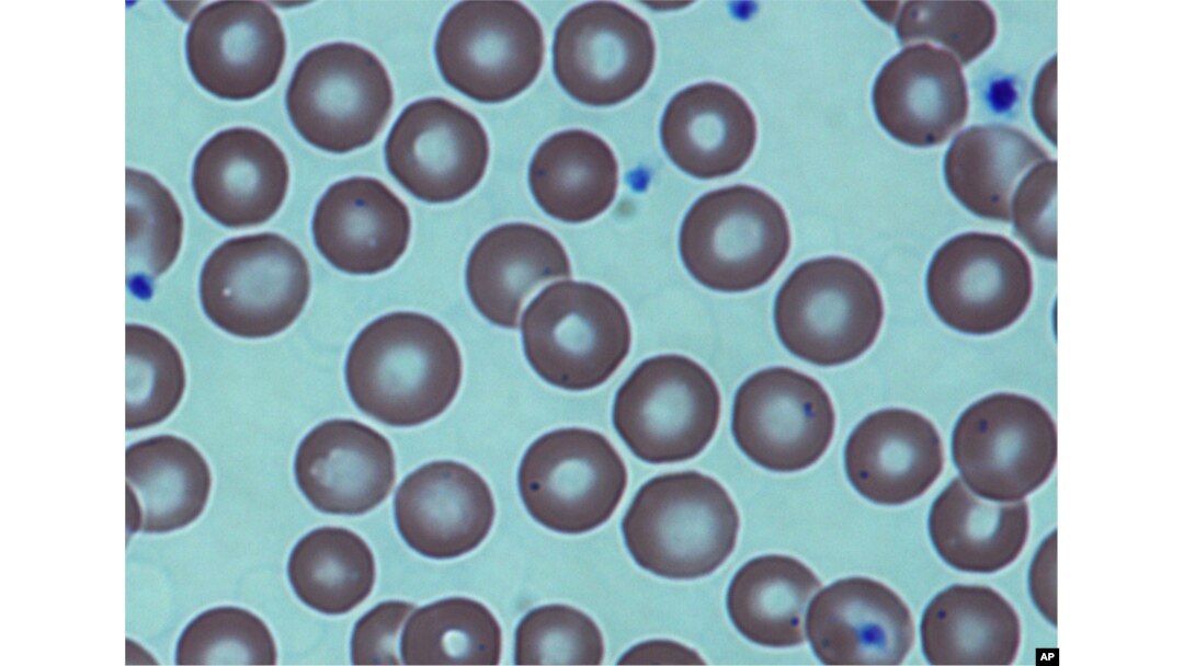 FILE - Red blood cells in a sickle cell patient, after a bone marrow transplant at the National Institutes of Health Clinical Center in Bethesda, Md. Medical Association.