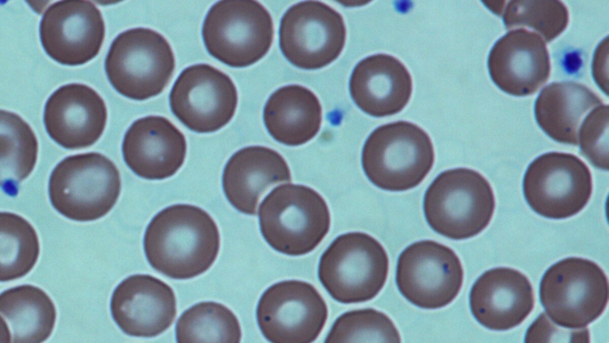 Sickle cell anemia disebabkan oleh
