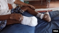 An amputated leg, claw toes and claw hands of leprosy patient Gopal Bag are seen at the Leprosy Mission Trust India hospital, Kolkata, Sept. 20 2016. (M. Hussain/VOA)