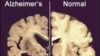 Ilmuwan AS Berhasil Identifikasi Gen Terkait Alzheimer