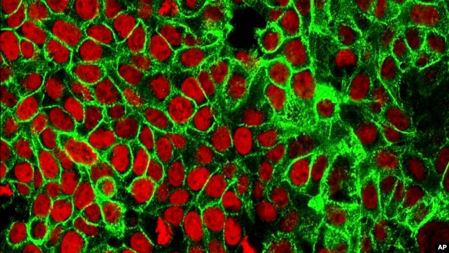 This microscope image made available by the National Cancer Institute Center for Cancer Research in 2015 shows human colon cancer cells with the nuclei stained red. (NCI Center for Cancer Research via AP, File) 