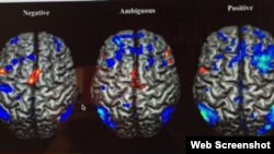 Proyecciones tridimensionales de activaciones y desactivaciones durante pruebas de improvisación para condiciones de diferentes emociones. Foto tomada de sitio web http:www.nature.com/articles/srep18460