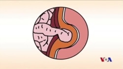 အူကျရောဂါဖြစ်ဖို့ တွန်းအားမြင့်စေတဲ့ အနေအထိုင် အပြုအမူတွေ