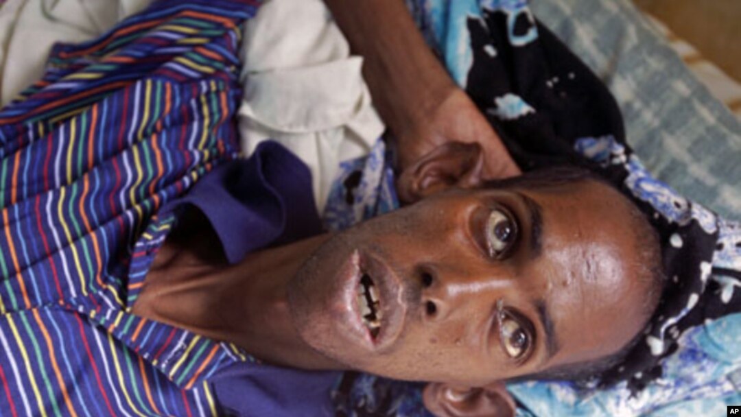 A malnourished Somali refugee at a field hospital of the International Rescue Committee, IRC, in Dadaab, Kenya, Wednesday, Aug. 3, 2011.