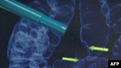 Mënyrë e re trajtimi për kancerin e mushkërive