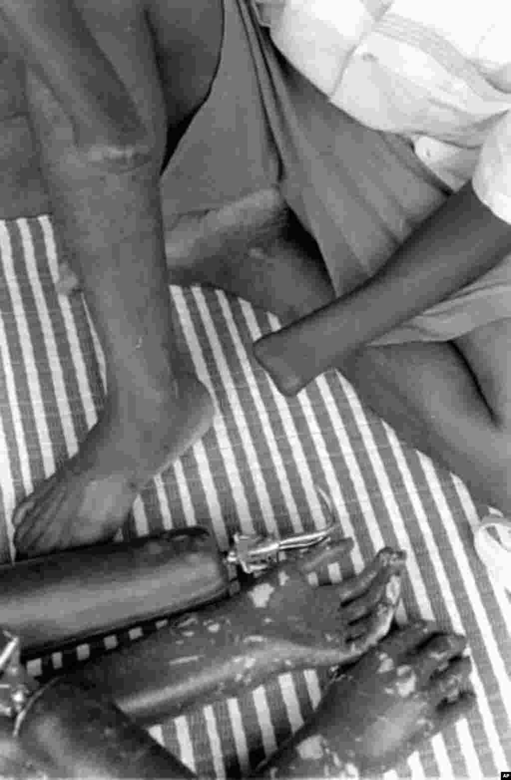 Victims of the rebels in Sierra Leone in a refugee camp in Guinea, 2000. (N. Barge/VOA)