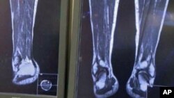 Soccer Injuries