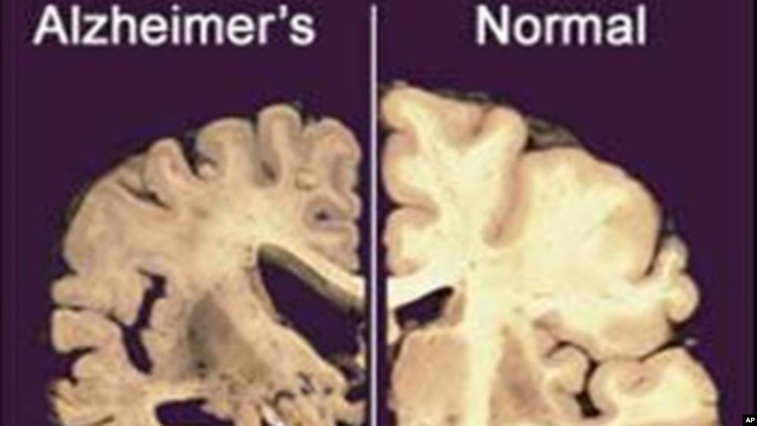 Peneliti kini percaya, Alzheimer mulai membunuhi sel-sel otak bertahun-tahun sebelum ada gejala yang jelas (foto: Dok)