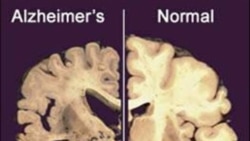 새 혈액검사법, 알츠하이머 진단 쉬워져