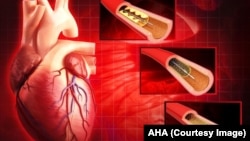 بندش شریان‌های قلبی و مشکلات ناشی از آن همه ساله سبب مرگ ۳۷۰ هزار نفر در امریکا می‌شود.