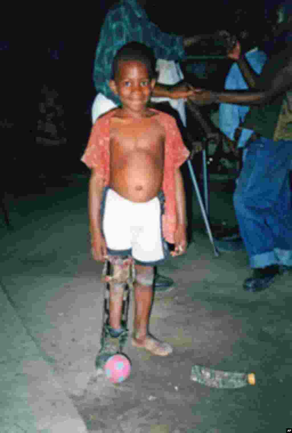 Corrective treatment is often not available and children grow up with contorted and constricted limbs.