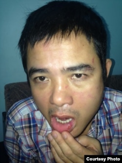 Những vết thương trên mặt anh Lê Quốc Quyết sau khi bị mật vụ truy sát (Ảnh: Danlambao)