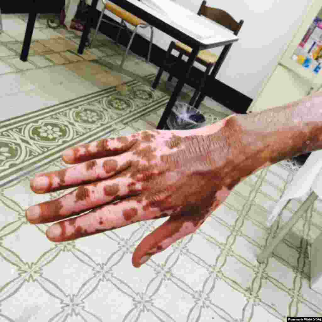 This man&#39;s hand was burned by smugglers. He was trying to reach Libya and then travel onward to Europe. (photo provided by a doctor in a Milan, Italy medical center) &nbsp;