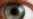 Procedure Could Reverse Common Form of Blindness