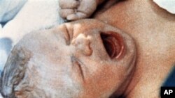 Louise Brown, premier bébé-éprouvette au monde, né le 25 juillet 1978, au Oldham General Hospital de Manchester, en Angleterre. 