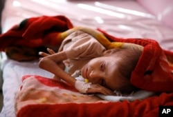 Foto seorang anak yang dirawat akibat malnutrisi di salah satu rumah sakit perawatan gizi di Sana'a, Yaman, 24 Januari 2016. (Foto: dok).