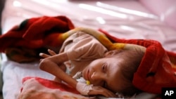 FILE - A malnourished child lies in a bed waiting to receive treatment at a therapeutic feeding center in a hospital in Sana'a, Yemen, Jan. 24, 2016.