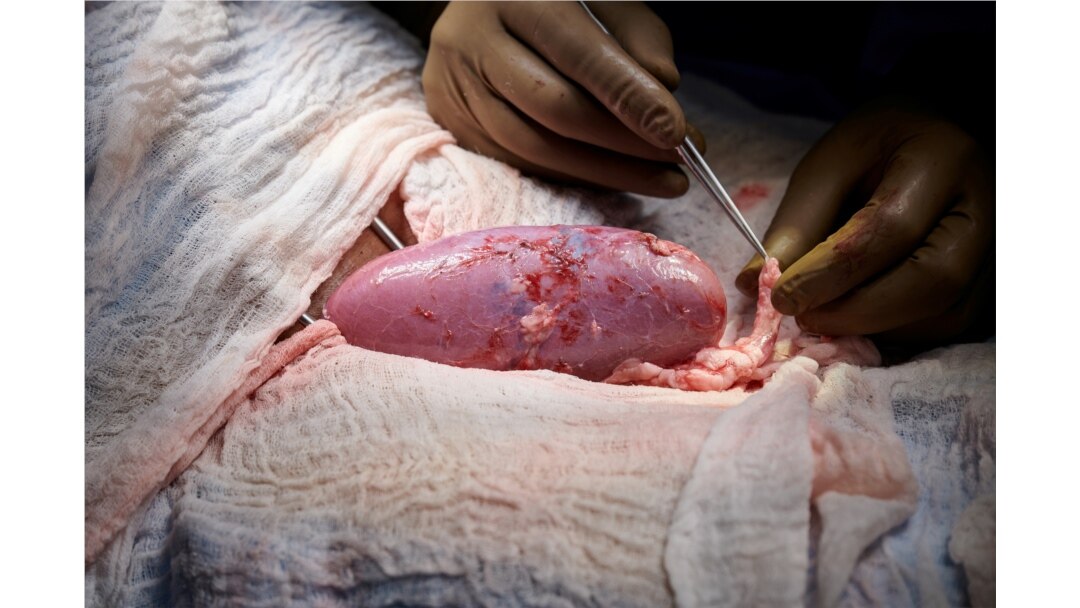 Ginjal babi hasil rekayasa genetika tampak sehat selama operasi transplantasi di NYU Langone di New York, AS (Foto: Joe Carrotta untuk NYU Langone Health via REUTERS)