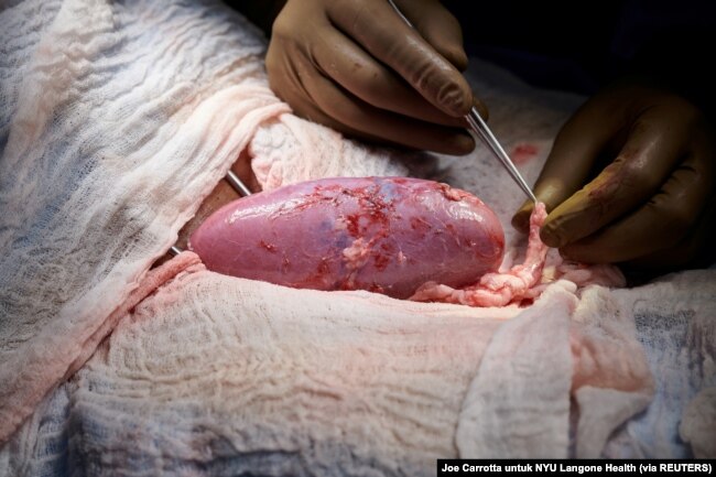 Ginjal babi hasil rekayasa genetika tampak sehat selama operasi transplantasi di NYU Langone di New York, AS (Foto: Joe Carrotta untuk NYU Langone Health via REUTERS)