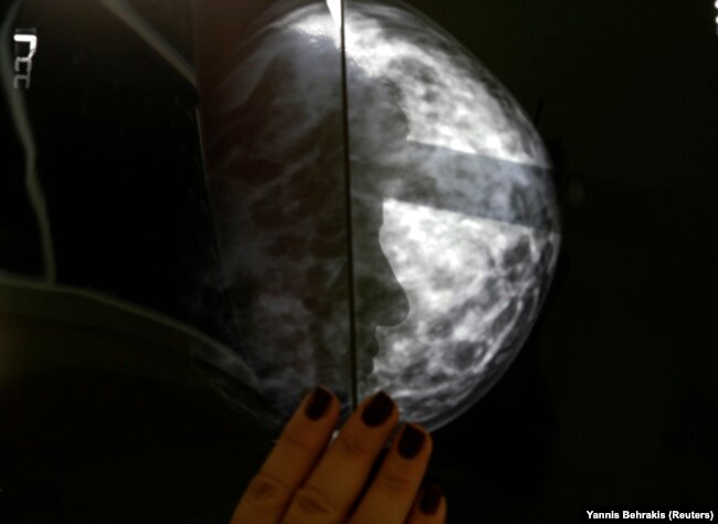 Seorang pasien kanker payudara Yunani menunjukkan hasil x-ray setelah pemeriksaan radiologis di sebuah rumah sakit. (Foto: REUTERS/Yannis Behrakis)