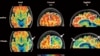 Alzheimer’s Drugs May Reach Brain Faster with Ultrasound Tool