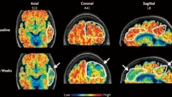 Quiz - Alzheimer’s Drugs May Reach Brain Faster with Ultrasound Tool