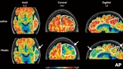 These PET scan images provided by the New England Journal of Medicine in January 2024 show a reduction in amyloid-beta levels in an Alzheimer's patient after focused ultrasound treatment to open the blood-brain barrier after 26 weeks. (New England Journal of Medicine via AP)