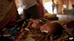 Bé Zara Mahamat ở Chad, bị suy dinh dưỡng, tiêu chảy, và sốt đang được điều trị qua một ống truyền thức ăn qua mũi.