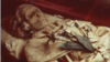 Tuberculosis Found in 18th Century Bodies