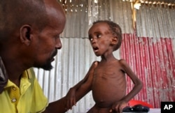 FILE - Father Ali Madey holds his malnourished child Mohamed Ali, 5, in their camp for the displaced on the outskirts of Mogadishu, Somalia, May 25, 2017.