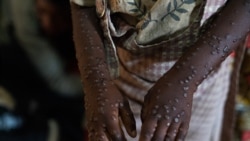 Doubts over imminent delivery of mpox vaccines to Congo