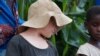 Attacks on Albinos Resurface in Malawi; UN Offers to Help 