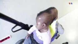 Գլխով իրար կպած 2 տարեկան երկվորյակ երեխաներին իտալացի բժիշկները բացառիկ վիրահատությամբ առանձնացրել են