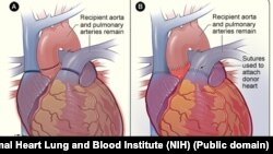ຫົວໃຈທີ່ເປັນພະຍາດ (ຊ້າຍ) ຖືກຕັດອອກ ແລະຖືກປ່ຽນແທນດ້ວຍຫົວໃຈໃໝ່ ທີ່ໄດ້ຮັບບໍລິຈາກ ຈາກຄົນອື່ນ. (Credit NIH) 