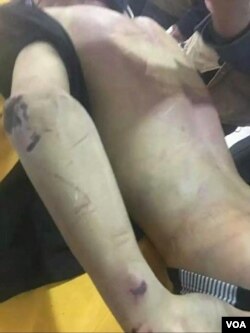 赵鑫遗体背部伤痕累累