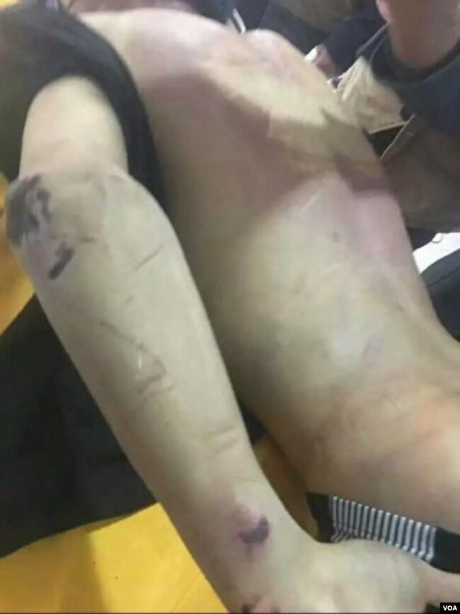 赵鑫遗体背部伤痕累累